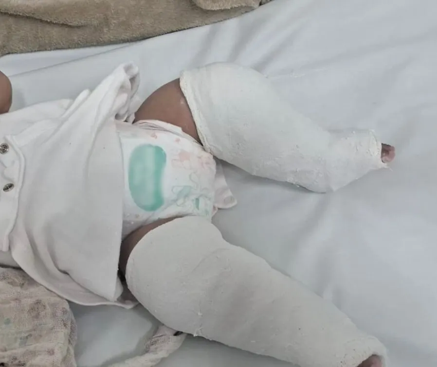 Bebê de quatro meses dá entrada na Santa Casa com braços e pernas quebrados