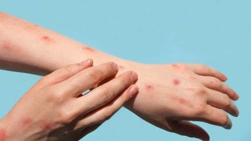 Prefeitura de Sumaré confirma primeiro caso de mpox em 2026; paciente já recebeu alta